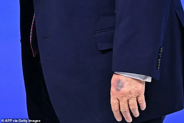 Trump Claims Davos Bruise from 'Clipping Table,' Experts Question Explanation