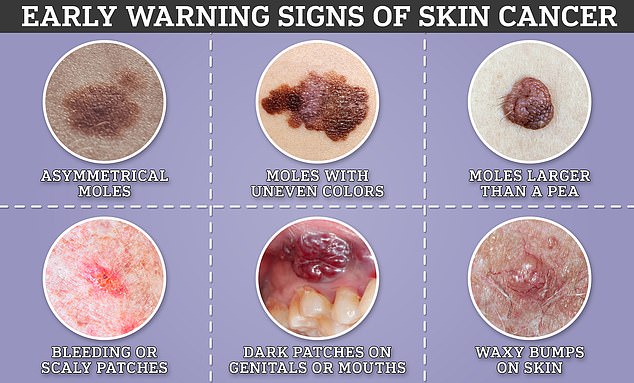 Skin cancer cases poised to surge globally by 2050, driven by UV exposure.
